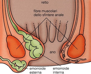 fastidio anale, sanguinamento anale, sanguinamento emorroidi, trattamento emorroidi