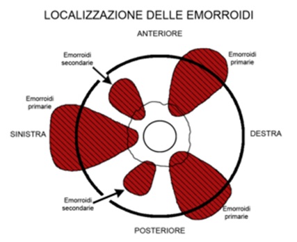 Cosa sono le emorroidi